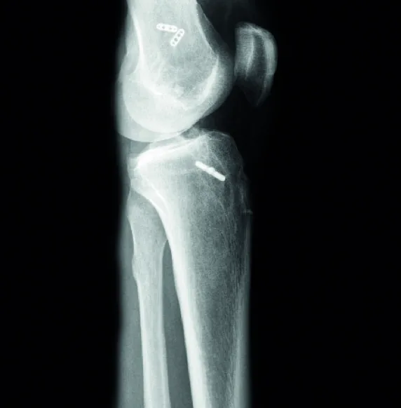 Preoperative xray 02